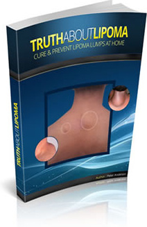 Ebook cover: Truth About Lipoma
